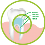 exposed dentine