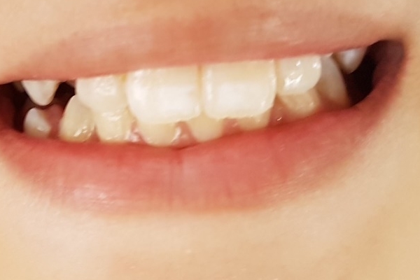 Can professional teeth whitening damage teeth