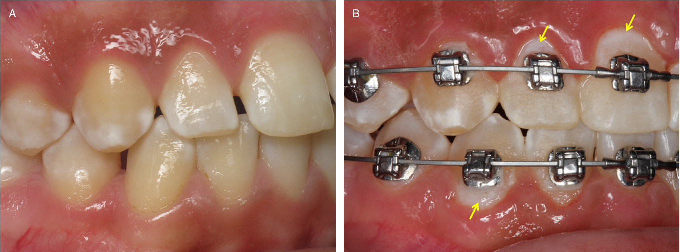 orthodontic white spot lesions