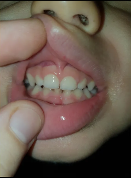 After Hypodemineralised teeth