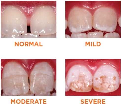 Enamel Hypoplasia